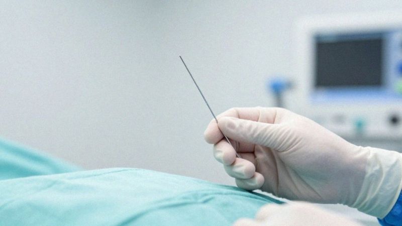 Jak zapobiegać bólowi lędźwiowemu po znieczuleniu podpajęczynówkowym?